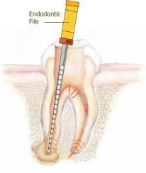 laserrootcanal Pic 1