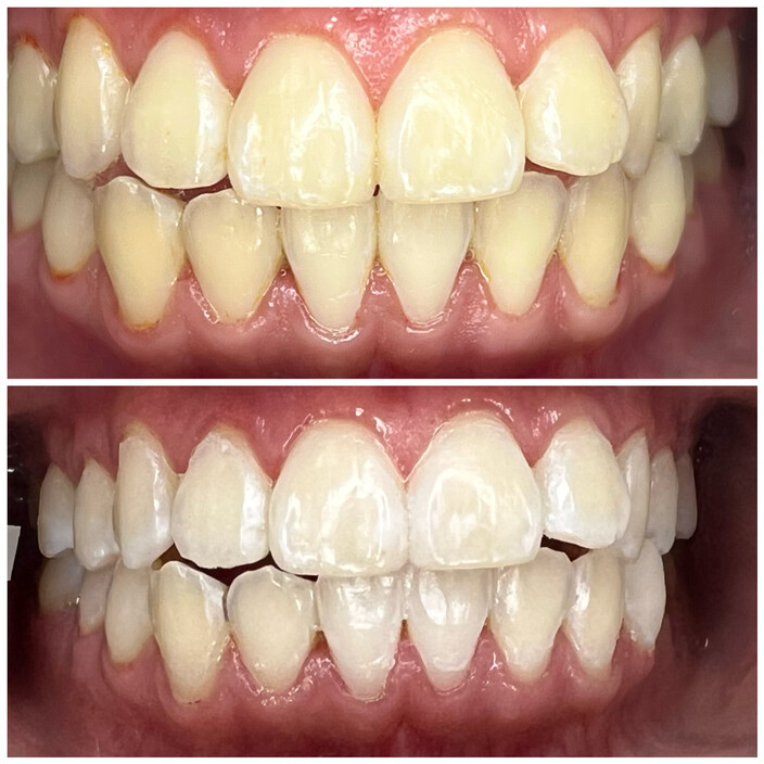 Whiten Up Teeth Whitening Pic 1 - Platinum Teeth Whitening