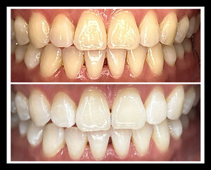 Whiten Up Teeth Whitening Pic 3 - Platinum Teeth Whitening