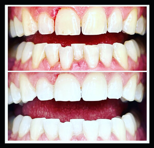 Whiten Up Teeth Whitening Pic 4 - Platinum Teeth Whitening