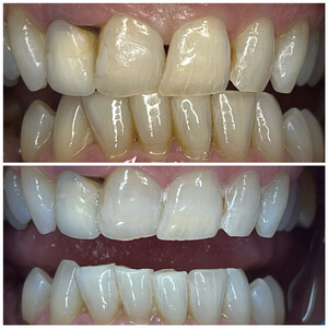 Whiten Up Teeth Whitening Pic 5 - Platinum Teeth Whitening