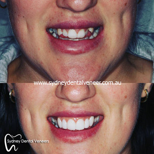 Sydney Dental Veneers Pic 4