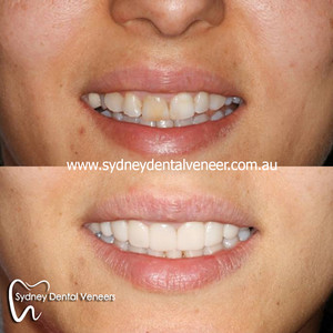 Sydney Dental Veneers Pic 3