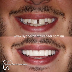 Sydney Dental Veneers Pic 2