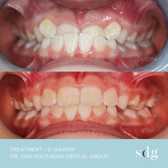 Teeth whitening reviews brisbane
