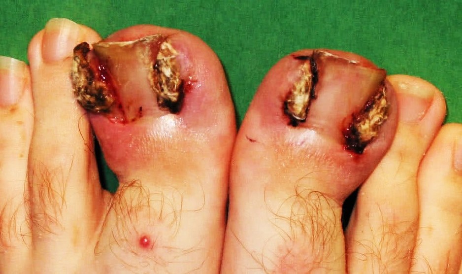 Dr Craig Bagley Podiatrist Pic 1 - This was before the surgery After looks like normal feet thanks Craig