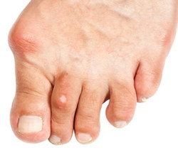 Perth Foot Centre Pic 2 - Bunion and Hammertoe deformity