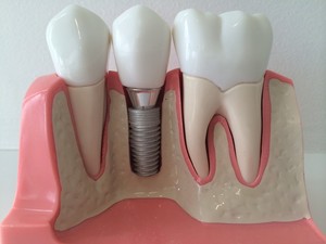 Nambucca Dental Surgery Pic 2 - Implant dentistry