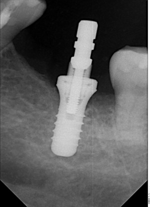 Nambucca Dental Surgery Pic 3 - Implant dentistry