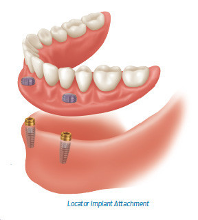 Nambucca Dental Surgery Pic 4 - Implant dentures