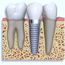 Sydney Dental Clinic Bankstown Pic 5 - Implant Dentistry