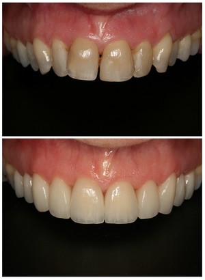 Dental 359 Pic 5 - Smile Makeover