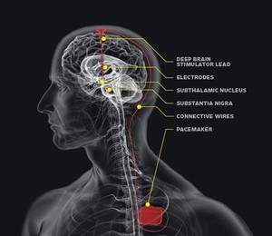 tDCS Brain Care Pic 2