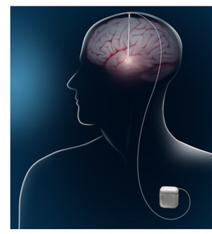 tDCS Brain Care Pic 3