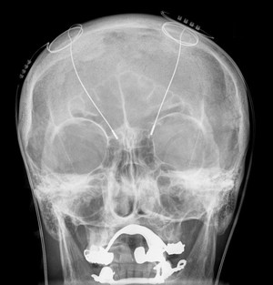 tDCS Brain Care Pic 5