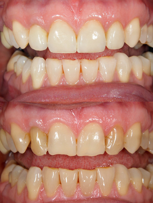 All Smiles Centre Pic 1 - Crowns and Veneers