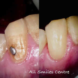 All Smiles Centre Pic 3 - White restoration