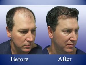 The Knudsen Clinic Pic 5 - Before After a Hair Transplant side