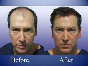 The Knudsen Clinic Pic 2 - Before After a Hair Transplant front on view