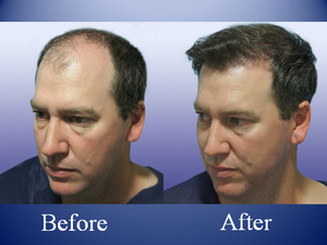 The Knudsen Clinic Pic 3 - Before After a Hair Transplant side on view