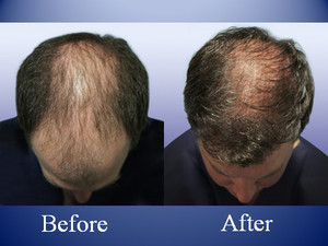 The Knudsen Clinic Pic 4 - Before After a Hair Transplant top view