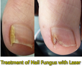 Brighton Podiatry Pic 1 - Nail Fungus Results