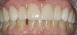 Chang Julia Dr Pic 1 - Full reconstruction of upper teethafter