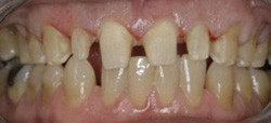 Chang Julia Dr Pic 2 - Full reconstruction of upper teethbefore