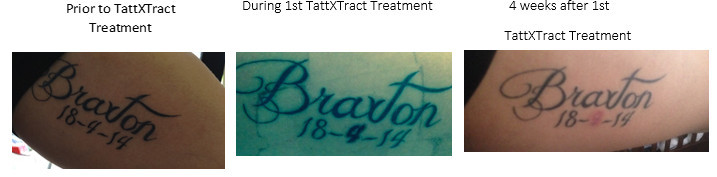 TattXtract Pic 1