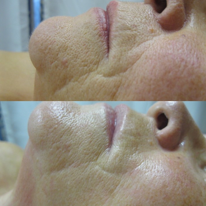 Unique U Age Management Clinic Pic 1 - One DMK Enzyme Therapy Treatment skin age 70 years old