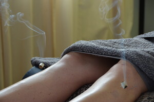 Mitchell Macgregor Pic 3 - Acupuncture with moxibustion