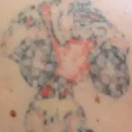 Lynn's Non Laser Tattoo Removal Pic 3