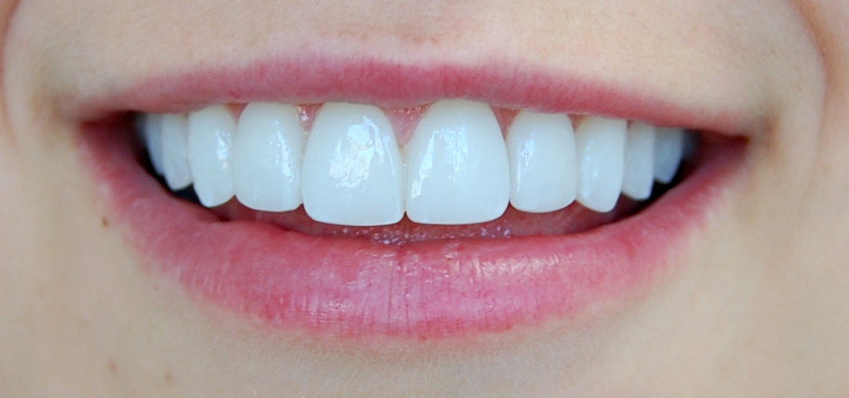 Brunswick East Dental Studio Pic 1 - Porcelain veneers