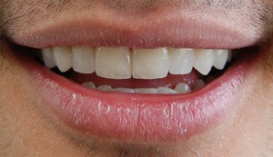 Brunswick East Dental Studio Pic 2 - Porcelain veneers