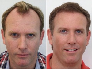 Medici Capelli Pic 4 - Before after hair transplant