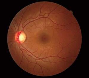 Eyecareplus Springvale Pic 5 - Optical Coherence Tomography OCT is one of the most advanced diagnostics tools available primarily used for the detection of macular degeneration glaucoma and diabetic eye disease