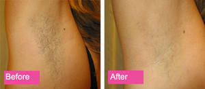 Essence Medispa Pic 2 - IPL Hair Removal