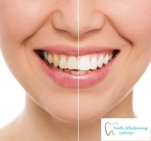 Teeth Whitening Sydney Pic 3