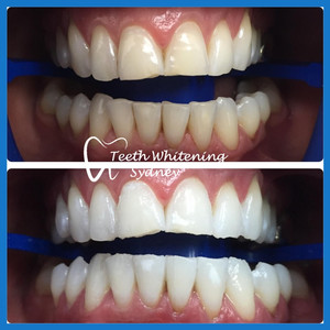 Teeth Whitening Sydney Pic 5