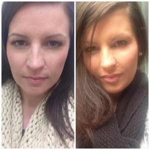 ABOUT FACE skin & hair Pic 4 - lips cheek augmentation with dermal filler by Michelle