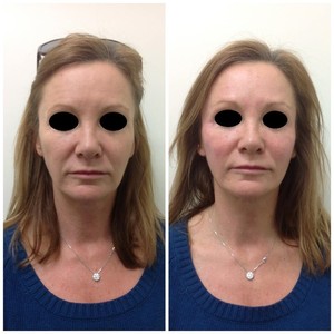 ABOUT FACE skin & hair Pic 3 - natural results with dermal fillers by Michelle