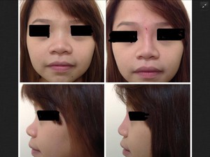 ABOUT FACE skin & hair Pic 5 - non surgical nose job with long lasting dermal filler by Michelle