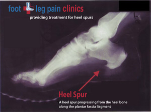 Foot + Leg Pain Clinics Pic 4 - treatment for heel spurs