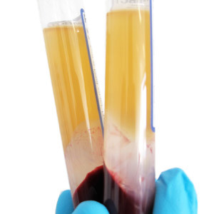 Dr John PRP Pic 1 - Platelet Rich Plasma