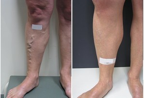 Vein Solutions Pic 5