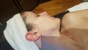 Adorable Beauty Pic 3 - face before Microdermabrasion and LED Light Therapy