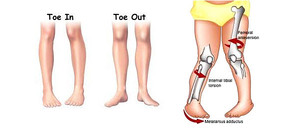 Perth Paediatric Surgeon Pic 4 - IntoeingOutToeing