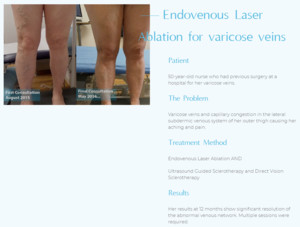 The Vein Institute Pic 5 - Before and after case