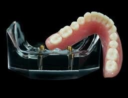 Geelong Denture Care Pic 4 - Implant dentures