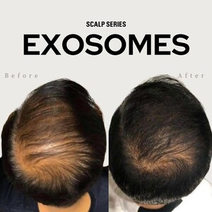 Scalp Series Pic 3 - Our Exosomes before and after